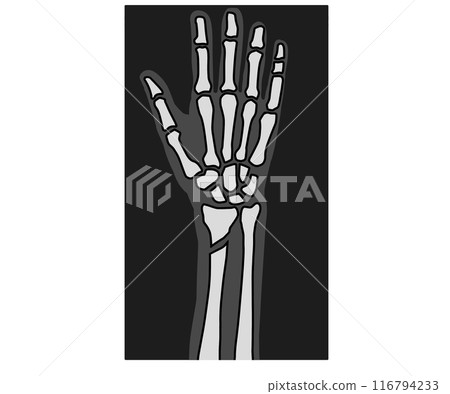 骨折X光檢查 骨折X光檢查 116794233