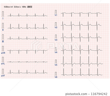 Normal twelve-lead electrocardiogram Normal twelve-lead electrocardiogram 116794242