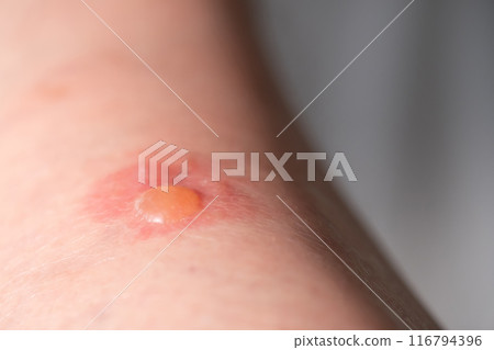 昆蟲叮咬的畫面 昆蟲叮咬的畫面 116794396