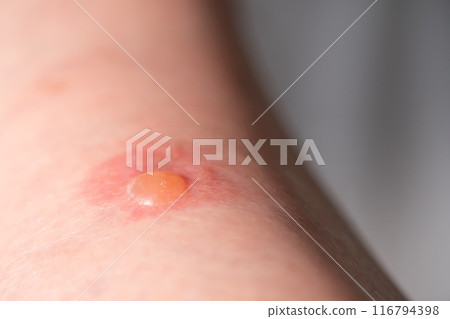Image of insect bites Image of insect bites 116794398