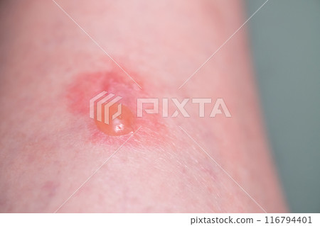 Image of insect bites Image of insect bites 116794401