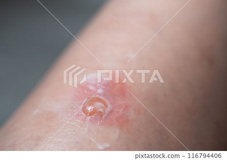 Image of insect bites Image of insect bites 116794406