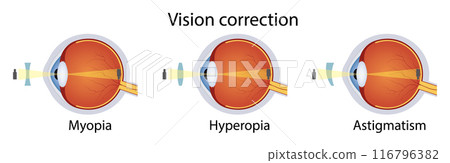 Correction of various eye vision disorders by lens. Hyperopia, myopia, astigmatism. Vector illustration 116796382