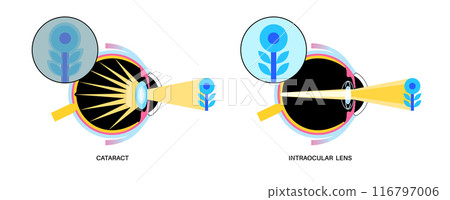 Intraocular lenses poster 116797006
