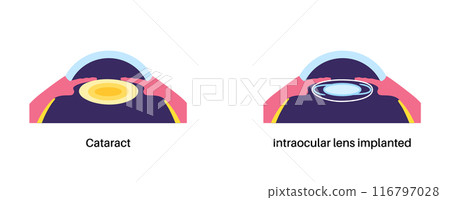 Intraocular lenses poster Intraocular lenses poster 116797028
