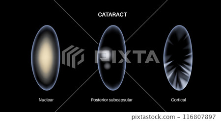 Cataract eye disease 116807897