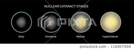 Cataract eye disease 116807898