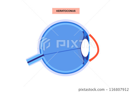 Cataract eye disease 116807912
