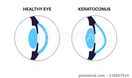 Cataract eye disease Cataract eye disease 116807914