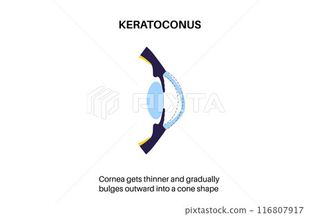 Cataract eye disease 116807917