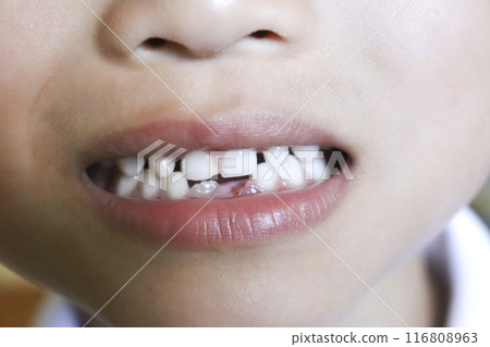 Child with missing lower teeth (6 years old/boy) 116808963