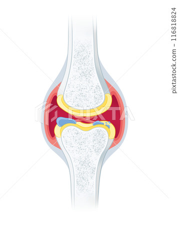 Osteoarthritis of the knee 116818824