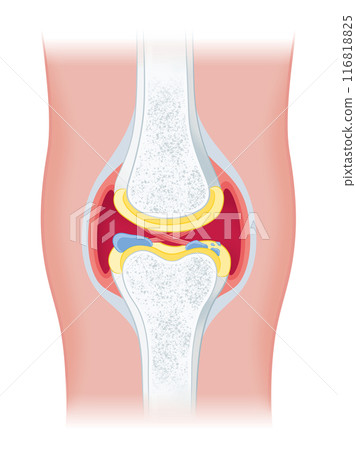 Osteoarthritis of the knee 116818825
