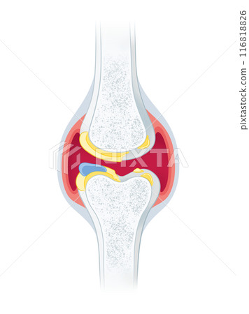 Osteoarthritis of the knee 116818826