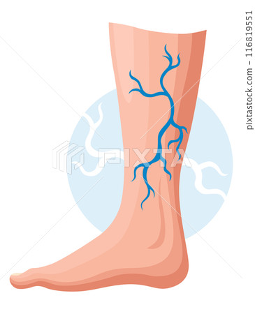 Stages or types of varicose veins development. Medical poster or disease infographic. Image of diseased legs. Vector illustration in flat style Stages or types of varicose veins development. Medical poster or disease infographic. Image of diseased legs. Vector illustration in flat style 116819551