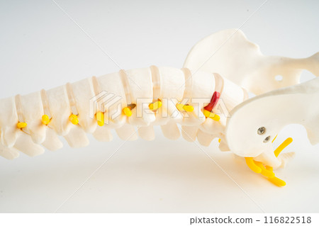Lumbar spine displaced herniated disc fragment, spinal nerve and bone. Model for treatment medical in the orthopedic department. Lumbar spine displaced herniated disc fragment, spinal nerve and bone. Model for treatment medical in the orthopedic department. 116822518