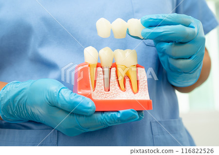 Dental implant, artificial tooth roots into jaw, root canal of dental treatment, gum disease, teeth model for dentist studying about dentistry. Dental implant, artificial tooth roots into jaw, root canal of dental treatment, gum disease, teeth model for dentist studying about dentistry. 116822526