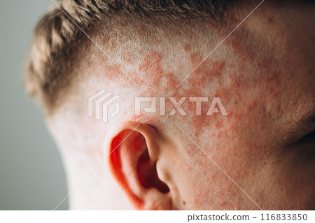 Psoriasis on the skin close-up, scalp, photos of dermatitis and eczema, skin problems concept, dermatology banner Psoriasis on the skin close-up, scalp, photos of dermatitis and eczema, skin problems concept, dermatology banner 116833850