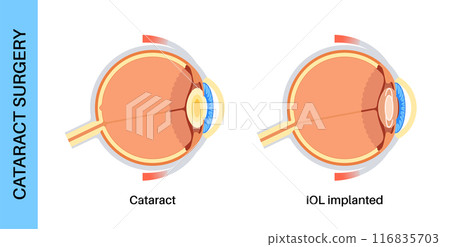 Intraocular lenses poster 116835703