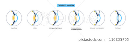 Cataract surgery poster Cataract surgery poster 116835705