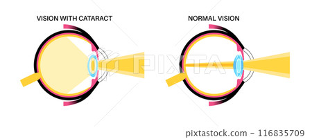 Intraocular lenses poster Intraocular lenses poster 116835709