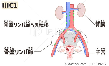 子宮癌IIIC1期(3C1期) 簡單易懂的日文插圖 子宮癌IIIC1期(3C1期) 簡單易懂的日文插圖 116839217