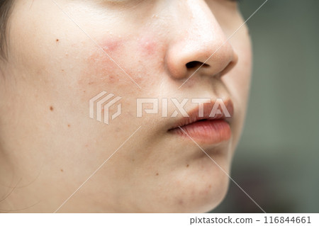 Asian young with pimple, acne, scar on skin, facial problem. 116844661