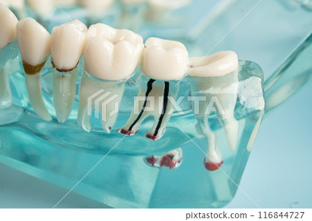 Dental implant, artificial tooth roots into jaw, root canal of dental treatment, gum disease, teeth model for dentist studying about dentistry. 116844727