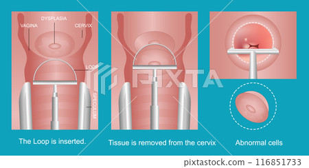 The loop electrosurgical excision procedure. The loop electrosurgical excision procedure. 116851733