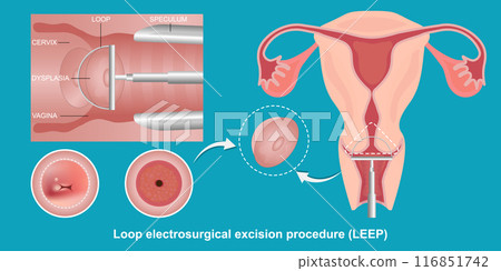 Loop electrosurgical. Loop electrosurgical. 116851742