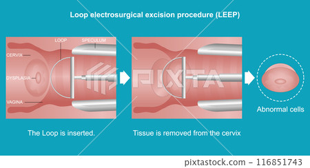LEEP (loop electrosurgical excision procedure). 116851743