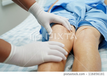 Doctor checking Asian elderly woman patient with scar knee replacement surgery in hospital. 116856181