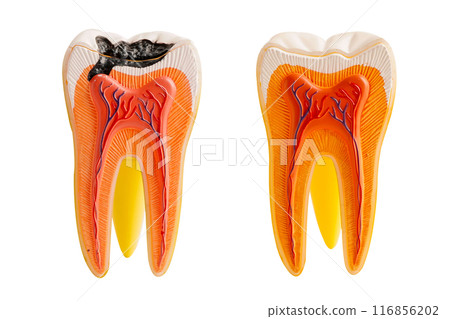 Decay tooth replace with dental implant root canal teeth model for education isolated on white background. Decay tooth replace with dental implant root canal teeth model for education isolated on white background. 116856202