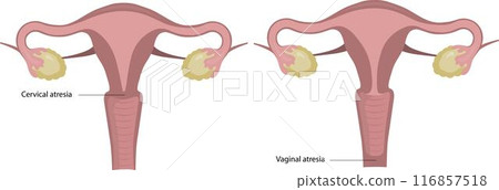 Developmental malformations of the uterus, vaginal atresia. 116857518