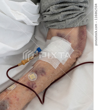 Unidentified senior person receiving blood transfusion serum in hospital room from her arm. Medical concept. 116862504
