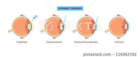 Cataract surgery poster 116862592