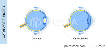 Intraocular lenses poster 116862594