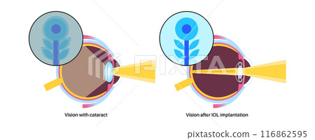 Intraocular lenses poster Intraocular lenses poster 116862595