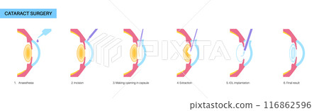 Cataract surgery poster Cataract surgery poster 116862596