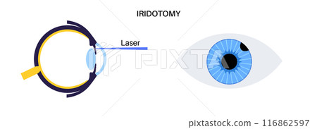 Iridectomy medical poster 116862597