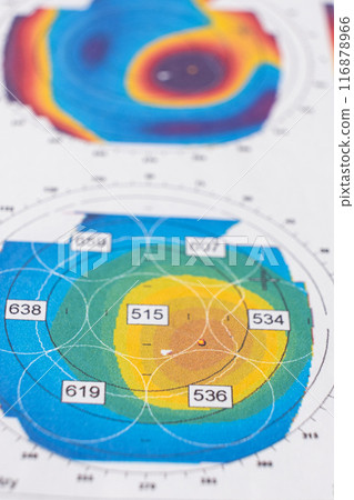 Results of the examination of the thickness and curvature of the cornea in a patient with keratoconus. Results of the examination of the thickness and curvature of the cornea in a patient with keratoconus. 116878966