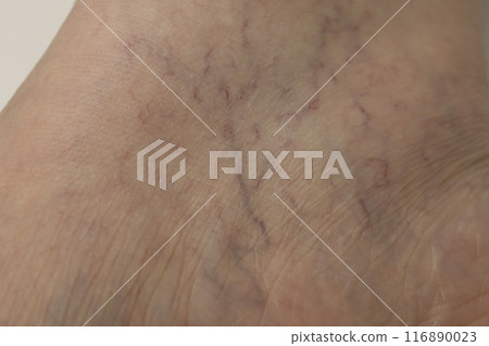 Varicose veins of the lower limbs, spider veins, reticular veins Varicose veins of the lower limbs, spider veins, reticular veins 116890023