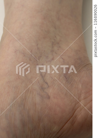 Varicose veins of the lower limbs, spider veins, reticular veins Varicose veins of the lower limbs, spider veins, reticular veins 116890026