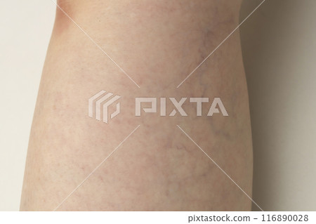 Varicose veins of the lower limbs, spider veins, reticular veins Varicose veins of the lower limbs, spider veins, reticular veins 116890028