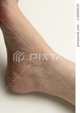 Varicose veins of the lower limbs, spider veins, reticular veins Varicose veins of the lower limbs, spider veins, reticular veins 116890030