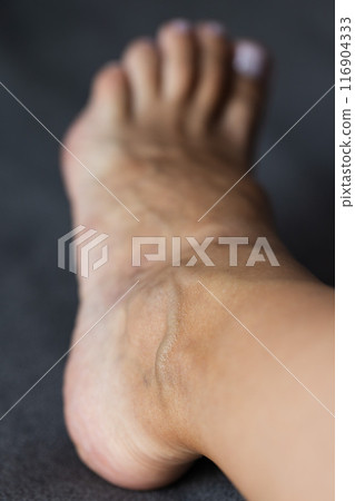 Large swollen vein on the female foot. Varicose veins, closeup. Large swollen vein on the female foot. Varicose veins, closeup. 116904333