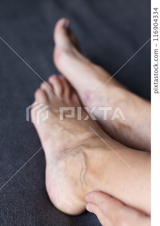 Woman gently touching her feet with large swollen veins. Varicose veins concept. Woman gently touching her feet with large swollen veins. Varicose veins concept. 116904334