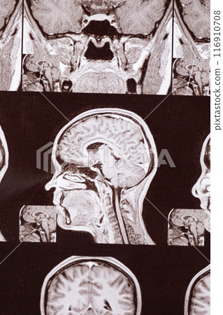 Magnetic resonance imaging of the head of a healthy person, image of the pituitary gland. 116910708
