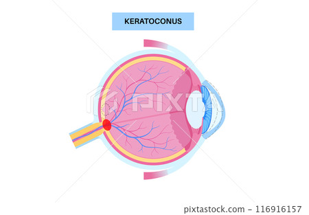 Cataract eye disease Cataract eye disease 116916157