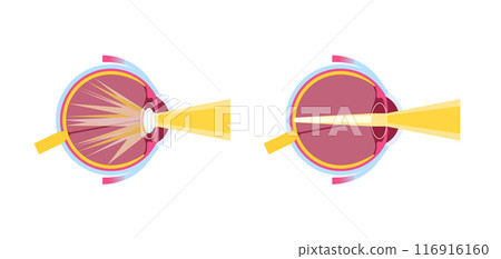 Cataract eye disease 116916160